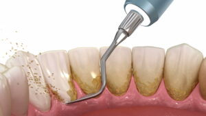 کاربرد اولتراسونیک در دندانپزشکی